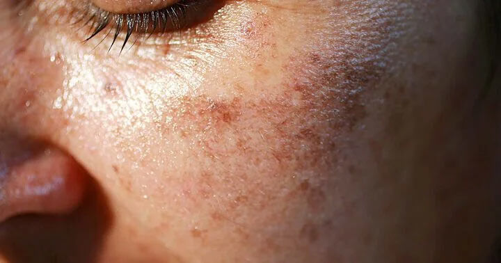 Orsaker för ojämn hudton